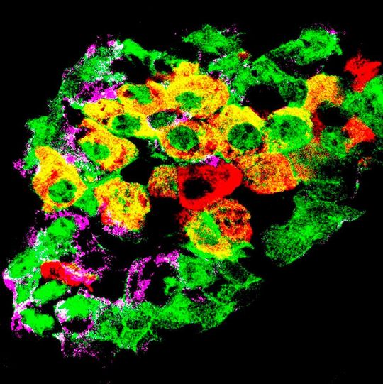 Mouse pancreatic islet in which the glucagon (purple)-producing alpha-cells have been labeled with a fluorescent tag (green). Some of them have started to produce insulin (red), and they appear as yellow (green-and-red merge). Mouse pancreatic islet in which the glucagon (purple)-producing alpha-cells have been labeled with a fluorescent tag (green). Some of them have started to produce insulin (red), and they appear as yellow (green-and-red merge).
