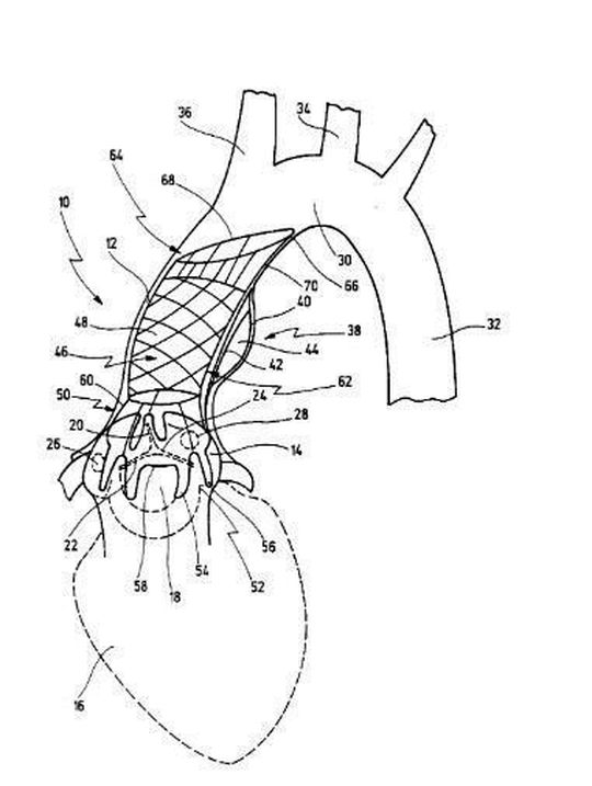 Endovaskulärer Stent zur Implantation in den aufsteigenden Ast der Aorta. Endovaskulärer Stent zur Implantation in den aufsteigenden Ast der Aorta.