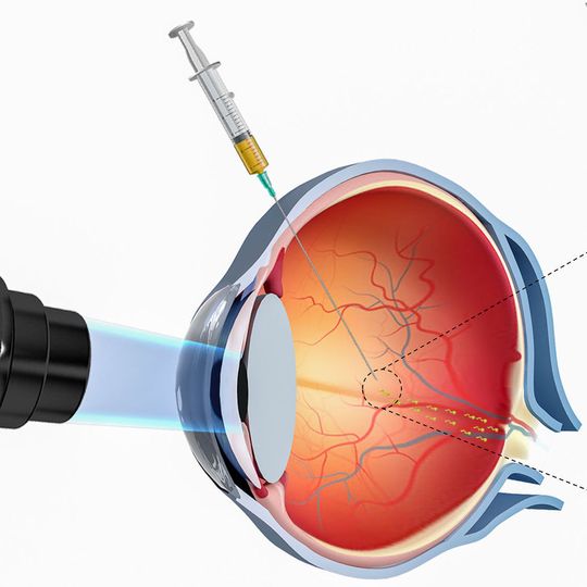 Nanoroboter werden ins Auge injiziert. (Ausschnitt) Nanoroboter werden ins Auge injiziert. (Ausschnitt)