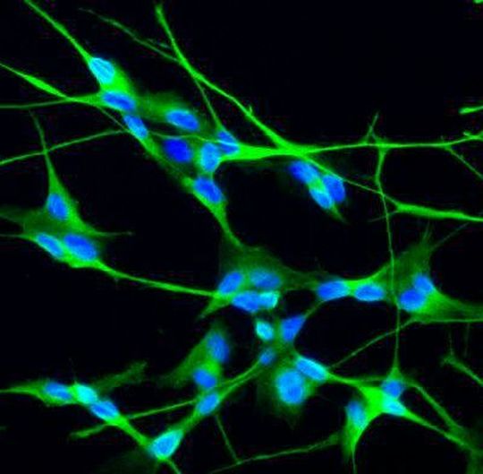 Neuronal differenzierte Zellen aus kindlichen Hirntumoren. Wissenschaftler des Universitätsklinikums Heidelberg entdeckten mit Hilfe dieser Zellen, dass die Aktivierung der Risiko-Gene für Autismus von der Bindung des Testosterons an einen sogenannten Androgen-Rezeptor abhängt. Neuronal differenzierte Zellen aus kindlichen Hirntumoren. Wissenschaftler des Universitätsklinikums Heidelberg entdeckten mit Hilfe dieser Zellen, dass die Aktivierung der Risiko-Gene für Autismus von der Bindung des Testosterons an einen sogenannten Androgen-Rezeptor abhängt.
