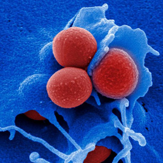 Invasion von multiresistenten MRSA Staphylococcus aureus in HEP-2 Epithelzelle Invasion von multiresistenten MRSA Staphylococcus aureus in HEP-2 Epithelzelle