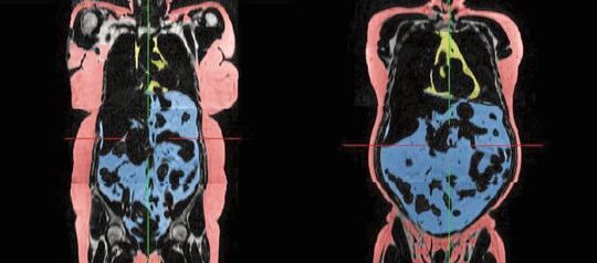 Sowohl beim Intervallfasten als auch bei einer herkömmlichen Diät verringert sich mit dem Körpergewicht das gesundheitsschädliche viszerale Fett (rechts, blau markiert). Unterhautfett (links, pink markiert) gilt als weniger riskant für die Gesundheit. Sowohl beim Intervallfasten als auch bei einer herkömmlichen Diät verringert sich mit dem Körpergewicht das gesundheitsschädliche viszerale Fett (rechts, blau markiert). Unterhautfett (links, pink markiert) gilt als weniger riskant für die Gesundheit.