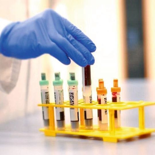 Alzheimer Diagnose Per Bluttest Lizenz Fur Usa