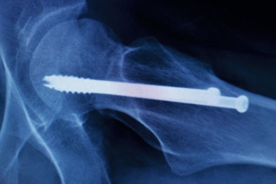 Medizinische Implantate stabilisieren beispielsweise verletzte Knochen und ermöglichen so deren Heilung. Medizinische Implantate stabilisieren beispielsweise verletzte Knochen und ermöglichen so deren Heilung.
