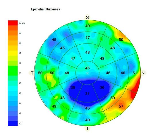 Zeiss Cirrus Epithelial Thickness Mapping Zeiss Cirrus Epithelial Thickness Mapping