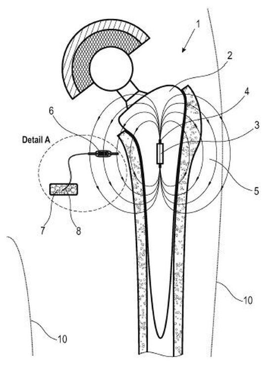 Endoprothesensystem. Endoprothesensystem.