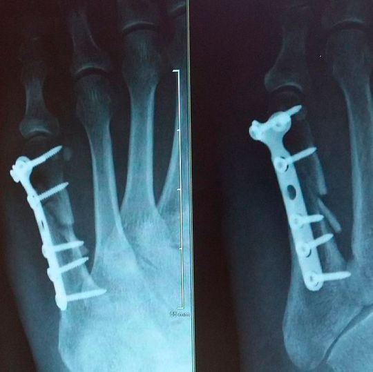 Nach Ansicht von Forschern ist die Medizin der Zukunft biologisch: Zerstörtes Gewebe wird demnach künftig durch biologisch funktionelles Gewebe aus dem 3D-Drucker ersetzt. Nun sind Forscher der Erzeugung von funktionalen Knochen per 3D-Druck einen deutlichen Schritt näher gekommen. Nach Ansicht von Forschern ist die Medizin der Zukunft biologisch: Zerstörtes Gewebe wird demnach künftig durch biologisch funktionelles Gewebe aus dem 3D-Drucker ersetzt. Nun sind Forscher der Erzeugung von funktionalen Knochen per 3D-Druck einen deutlichen Schritt näher gekommen.