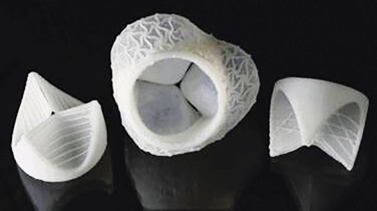 Die Klappenflügel (links und rechts) werden gezielt mit Silikonfäden verstärkt. Das gesamte Implantat umfasst zudem auch die Aortenwurzel (Mitte). Die Klappenflügel (links und rechts) werden gezielt mit Silikonfäden verstärkt. Das gesamte Implantat umfasst zudem auch die Aortenwurzel (Mitte).
