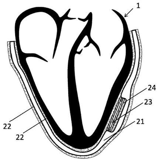 Herzunterstützungsvorrichtung mit strukturierter Oberfläche. Herzunterstützungsvorrichtung mit strukturierter Oberfläche.