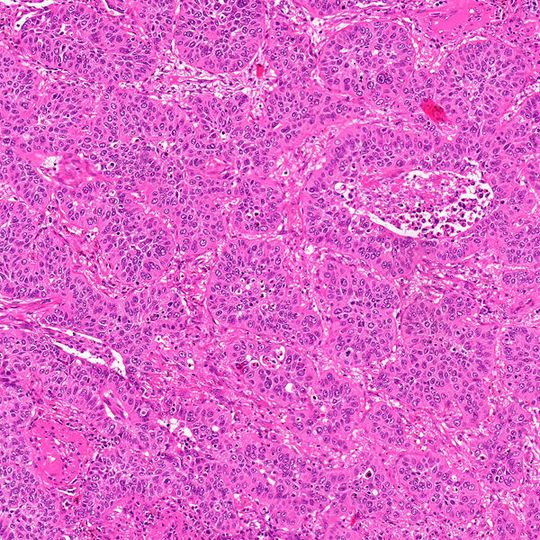 Histologisches Schnittpräparat eines primären Lungenkarzinoms. Histologisches Schnittpräparat eines primären Lungenkarzinoms.