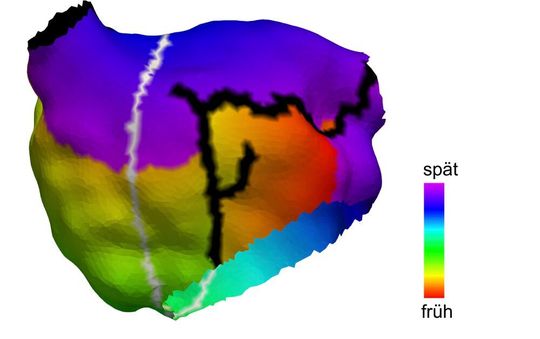 Anatomisches Modell des linken Vorhofs einer 70-jährigen Patientin. Schwarz: bestehende Ablationsnarben der vorherigen Behandlung. Grau: vom Algorithmus identifizierter Pfad, entlang dessen Vorhofflattern entstehen kann. Farbkodiert: klinisch gemessene Aktivierungszeit des aufgetretenen Vorhofflatterns. Anatomisches Modell des linken Vorhofs einer 70-jährigen Patientin. Schwarz: bestehende Ablationsnarben der vorherigen Behandlung. Grau: vom Algorithmus identifizierter Pfad, entlang dessen Vorhofflattern entstehen kann. Farbkodiert: klinisch gemessene Aktivierungszeit des aufgetretenen Vorhofflatterns.