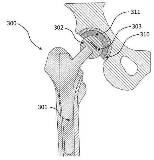 Implantat und Verfahren zur Diagnose und/oder Behandlung entzündlicher Gewebezustände. Implantat und Verfahren zur Diagnose und/oder Behandlung entzündlicher Gewebezustände.