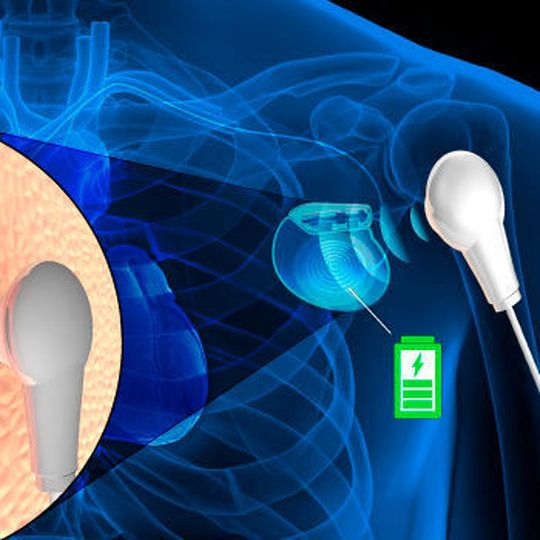 The team has developed a way to remotely charge a battery, such as that in a pacemaker, using a soft, biocompatible material that absorbs sound waves passed through the body. The team has developed a way to remotely charge a battery, such as that in a pacemaker, using a soft, biocompatible material that absorbs sound waves passed through the body.