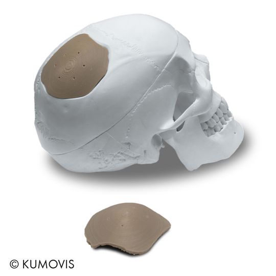 Mit dem 3D-Drucker R1 können individualisierter Medizinprodukte aus Hochleistungskunststoffen wie PEEK additiv gefertigt werden. Mit dem 3D-Drucker R1 können individualisierter Medizinprodukte aus Hochleistungskunststoffen wie PEEK additiv gefertigt werden.
