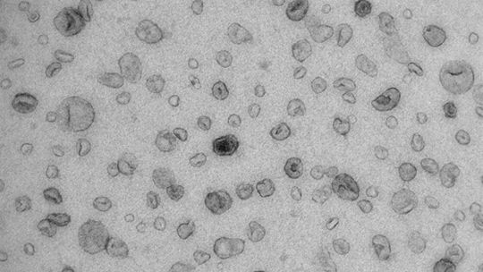 Electron microscopy image of the urinary extracellular vesicles studied. Electron microscopy image of the urinary extracellular vesicles studied.