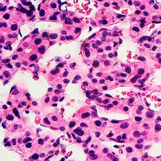 Microscopic image of hepatocellular carcinoma. Microscopic image of hepatocellular carcinoma.