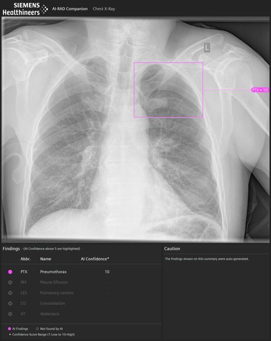 Posterior-Anterior-Thorax-Röntgenaufnahme eines Patienten mit einer Pneumothorax-Befundung im linken Lungenflügel durch AI-Rad Companion Chest X-ray. Posterior-Anterior-Thorax-Röntgenaufnahme eines Patienten mit einer Pneumothorax-Befundung im linken Lungenflügel durch AI-Rad Companion Chest X-ray.