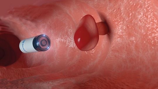 Dieses Röntgensystem auf Kapselbasis scannt den Dickdarm auf der Suche nach präkanzerösen Polypen. Die Patienten schlucken die Kapsel, in der ein Faulhaber-Miniaturantrieb arbeitet.