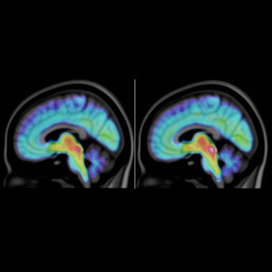 A visualisation of the average serotonin transporter concentration in people with ASD, autism spectrum disorder (left) and people without ASD (right). A visualisation of the average serotonin transporter concentration in people with ASD, autism spectrum disorder (left) and people without ASD (right).