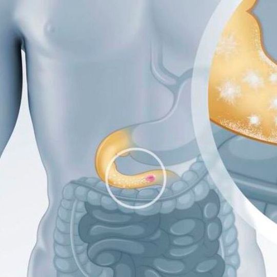 Eudratec Fasteric can increase gastric resistance and improve intestinal absorption for oral drug products that target sites in the upper small intestine. Eudratec Fasteric can increase gastric resistance and improve intestinal absorption for oral drug products that target sites in the upper small intestine.