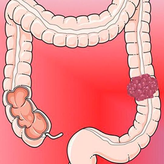 A schematic drawing of colon and colorectal carcinoma. A schematic drawing of colon and colorectal carcinoma.
