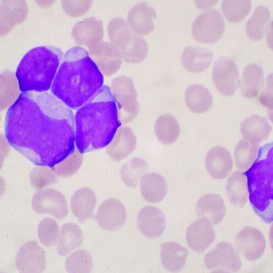 It is hoped that the findings will pave the way for new and more personalised therapies for acute myeloid leukaemia. It is hoped that the findings will pave the way for new and more personalised therapies for acute myeloid leukaemia.