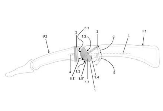 Eine Endoprothese für ein Fingergelenk. Eine Endoprothese für ein Fingergelenk.