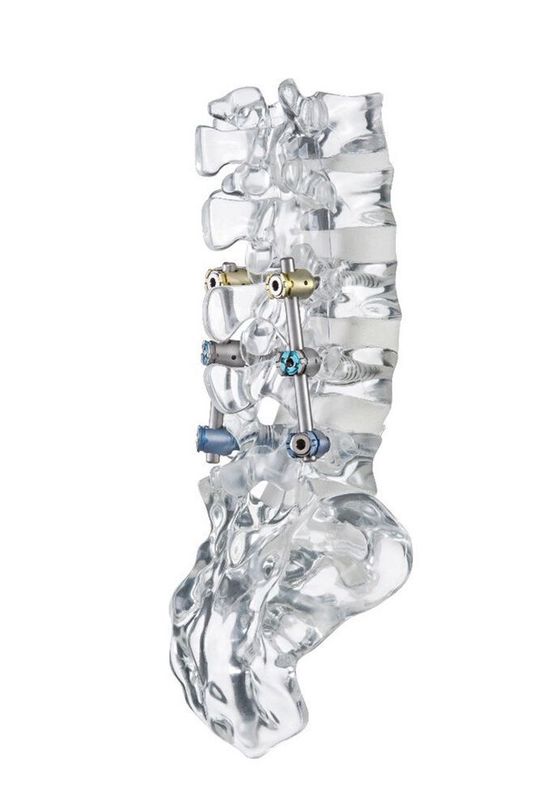 Das Stab-Schraubensystem U-Centum von Ulrich Medical ist nun auch steril verpackt verfügbar. Das Stab-Schraubensystem U-Centum von Ulrich Medical ist nun auch steril verpackt verfügbar.
