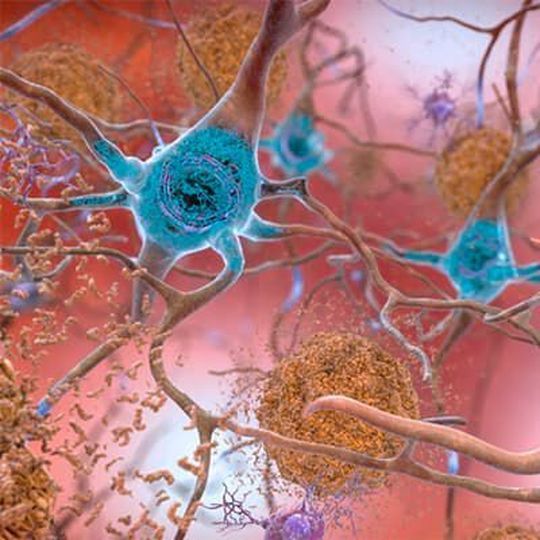 n this artist’s rendering, amyloid plaques are interspersed among neurons. These aggregates of misfolded proteins disrupt and kill brain cells, and are a hallmark of Alzheimer’s disease. n this artist’s rendering, amyloid plaques are interspersed among neurons. These aggregates of misfolded proteins disrupt and kill brain cells, and are a hallmark of Alzheimer’s disease.