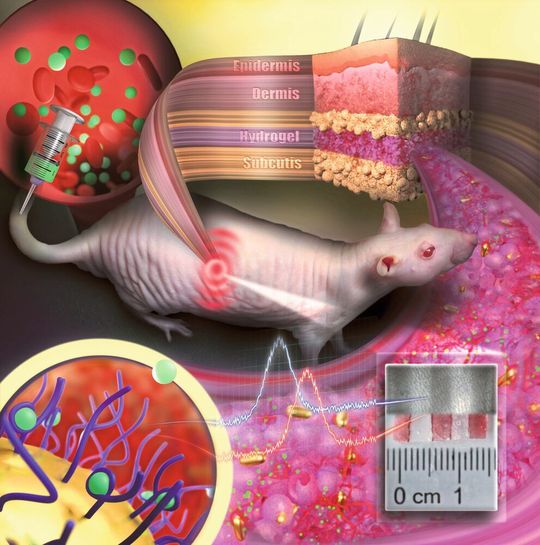 Goldnanopartikel in einem porösen Hydrogel werden als medizinische Sensoren unter die Haut implantiert. Sie wirken wie ein Tattoo, das Konzentrationsänderungen eines Arzneistoffs im Blut durch einen Farbwechsel anzeigt. Goldnanopartikel in einem porösen Hydrogel werden als medizinische Sensoren unter die Haut implantiert. Sie wirken wie ein Tattoo, das Konzentrationsänderungen eines Arzneistoffs im Blut durch einen Farbwechsel anzeigt.