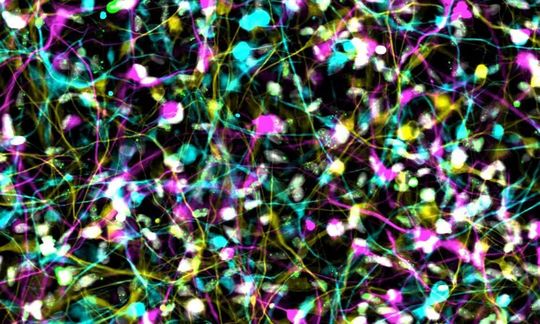 Die Abbildung zeigt induzierte Neuronen von Alzheimer-Patienten aus einer Immunfluoreszenz-Aufnahme. Die DNA-Schädigungen in diesen Nervenzellen sind durch grüne Punkte sichtbar. Die Abbildung zeigt induzierte Neuronen von Alzheimer-Patienten aus einer Immunfluoreszenz-Aufnahme. Die DNA-Schädigungen in diesen Nervenzellen sind durch grüne Punkte sichtbar.
