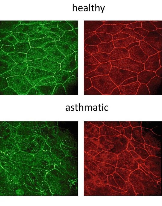 Gerade und klare Epithelbarriere von gesunden Bronchialepithelzellen (oben) und undichte und beschädigte asthmatische Epithelzellen (unten).