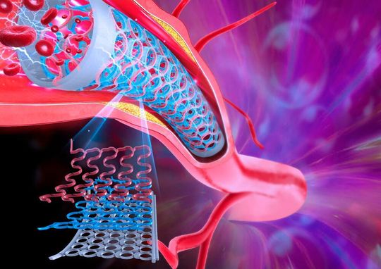 An illustration of the novel self-aware metamaterial system as used in a coronary artery stent. The design can sense restenosis when used in a stent, and the same design can be used at a large scale in bridge beams to to self-monitor for defects on the structure. An illustration of the novel self-aware metamaterial system as used in a coronary artery stent. The design can sense restenosis when used in a stent, and the same design can be used at a large scale in bridge beams to to self-monitor for defects on the structure.