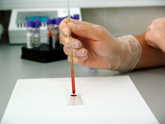 A transcription factor known as JunB is central for the formation of new blood vessels in the bone marrow of patients suffering from multiple myeloma (MM). A transcription factor known as JunB is central for the formation of new blood vessels in the bone marrow of patients suffering from multiple myeloma (MM).