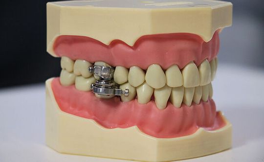 University of Otago and UK researchers have developed a world-first weight-loss device to help fight the global obesity epidemic. University of Otago and UK researchers have developed a world-first weight-loss device to help fight the global obesity epidemic.