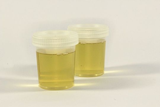 Urinproben können helfen, schwere Verläufe von Covid-19 vorherzusagen. Urinproben können helfen, schwere Verläufe von Covid-19 vorherzusagen.