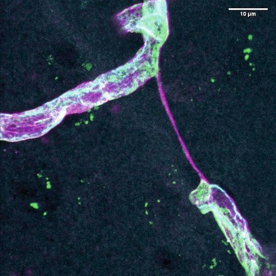 SARS-CoV-2 führt im Gehirn von verstorbenen Covid-19-Patienten sowie in Tiermodellen zum Absterben von kleinen Blutgefäßen, hier beispielhaft dargestellt durch die verbliebene aber nicht mehr durchblutete äußere Hülle (magenta, Kollagen IV) ohne Endothelzellen (grün, CD31). SARS-CoV-2 führt im Gehirn von verstorbenen Covid-19-Patienten sowie in Tiermodellen zum Absterben von kleinen Blutgefäßen, hier beispielhaft dargestellt durch die verbliebene aber nicht mehr durchblutete äußere Hülle (magenta, Kollagen IV) ohne Endothelzellen (grün, CD31).