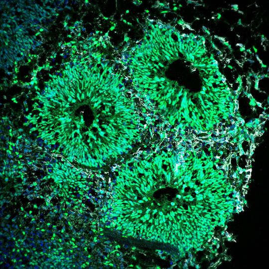 Menschliches Gehirnorganoid mit Ventrikeln, die aus neuralen Vorläuferzellen (grün) und neugeborenen Neuronen (grau) bestehen Menschliches Gehirnorganoid mit Ventrikeln, die aus neuralen Vorläuferzellen (grün) und neugeborenen Neuronen (grau) bestehen