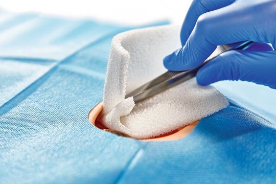 Der hydrophile Debridement-Schaum eignet sich gut für die Reinigung von tiefen und schwer zugänglichen Wunden. Der hydrophile Debridement-Schaum eignet sich gut für die Reinigung von tiefen und schwer zugänglichen Wunden.
