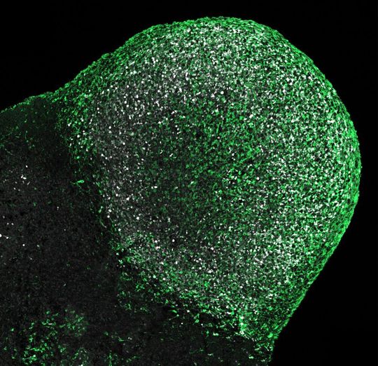 Tumor auf einem von einem Tuberöse-Sklerose (TSC)-Patienten stammenden Hirnorganoid Tumor auf einem von einem Tuberöse-Sklerose (TSC)-Patienten stammenden Hirnorganoid