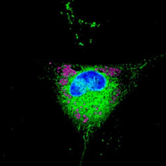 An astrocyte that stores lipids in droplets (pink) and starts secreting toxic lipids in the surrounding tissue. An astrocyte that stores lipids in droplets (pink) and starts secreting toxic lipids in the surrounding tissue.