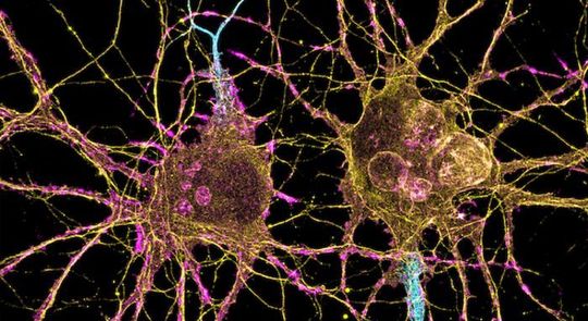 Parkinson's disease is not usually seen as an autoimmune disease. Parkinson's disease is not usually seen as an autoimmune disease.