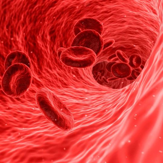 Deleting the TRPM2 protein from macrophages reduced atherosclerosis in mice. Deleting the TRPM2 protein from macrophages reduced atherosclerosis in mice.