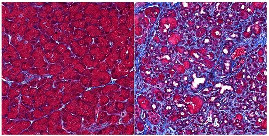 Left: Acinar cells (red) in a healthy pancreas. Right: Extensive pancreatic scarring (purple) when ERR gamma is lost from acinar cells.