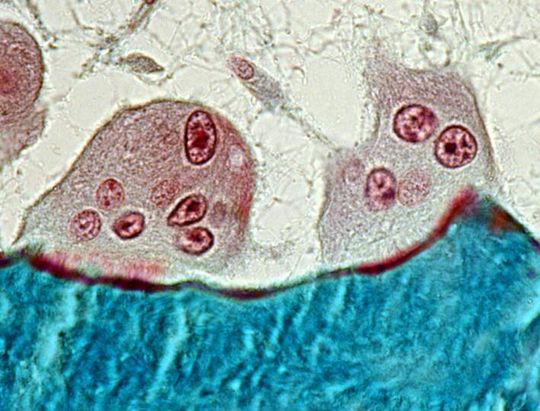 Feingeweblicher Schnitt vom Knochen eines Osteoporose Patienten. Zu sehen sind zwei Osteoklasten (mehrkernige Zellen), die den Knochen (blau) gerade zerstören. Feingeweblicher Schnitt vom Knochen eines Osteoporose Patienten. Zu sehen sind zwei Osteoklasten (mehrkernige Zellen), die den Knochen (blau) gerade zerstören.