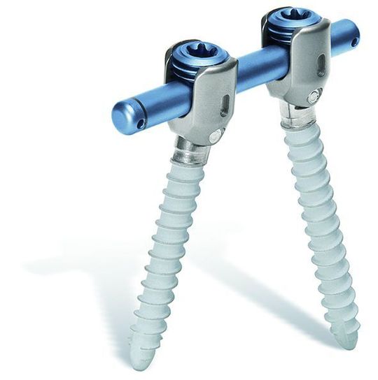 Hohlgebohrte Cosmic-Schrauben als Therapievariante zur dynamischen Stabilisierung der Wirbelsäule. (Bild: Rofin)