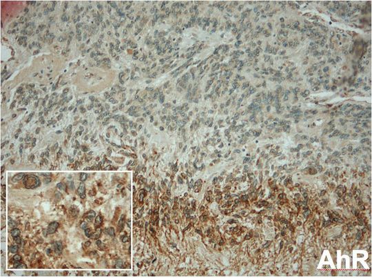 Im Hirntumorgewebe kann der Dioxin-Rezeptor AHR (braun) in denselben Arealen wie das Enzym TDO nachgewiesen werden. (Färbung: Felix Sahm, Abteilung Neuropathologie, Universitätsklinikum Heidelberg) (Bild: Nature) Im Hirntumorgewebe kann der Dioxin-Rezeptor AHR (braun) in denselben Arealen wie das Enzym TDO nachgewiesen werden. (Färbung: Felix Sahm, Abteilung Neuropathologie, Universitätsklinikum Heidelberg) (Bild: Nature)