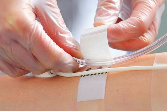 Bild 1: Die „BeneHold“-Fixierstreifen lassen sich auch mit Handschuhen leicht verwenden Bild 1: Die „BeneHold“-Fixierstreifen lassen sich auch mit Handschuhen leicht verwenden