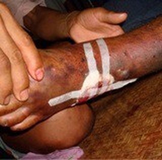 Vergiftung durch Kettenviperbiss (Daboia siamensis) in Myanmar. Das Gift verhindert die Blutgerinnung und verursacht dadurch innere und äußere Blutungen. Außerdem zerstört es Muskeln und Nieren. Vergiftung durch Kettenviperbiss (Daboia siamensis) in Myanmar. Das Gift verhindert die Blutgerinnung und verursacht dadurch innere und äußere Blutungen. Außerdem zerstört es Muskeln und Nieren.
