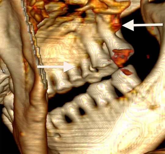 Blick auf die rechte Seite der Zahnreihen (3D-Rekonstruktion). Pfeil nach rechts: tiefe kariöse Läsionen, Pfeil nach links: starker Knochenschwund der Backenzähne Blick auf die rechte Seite der Zahnreihen (3D-Rekonstruktion). Pfeil nach rechts: tiefe kariöse Läsionen, Pfeil nach links: starker Knochenschwund der Backenzähne